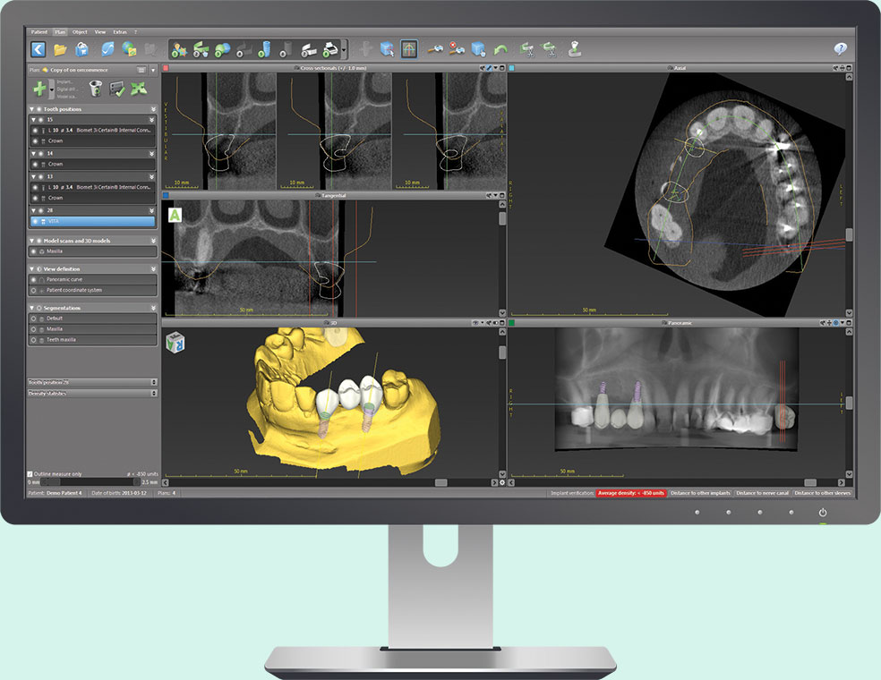 Phần Mềm Thiết Kế Implant